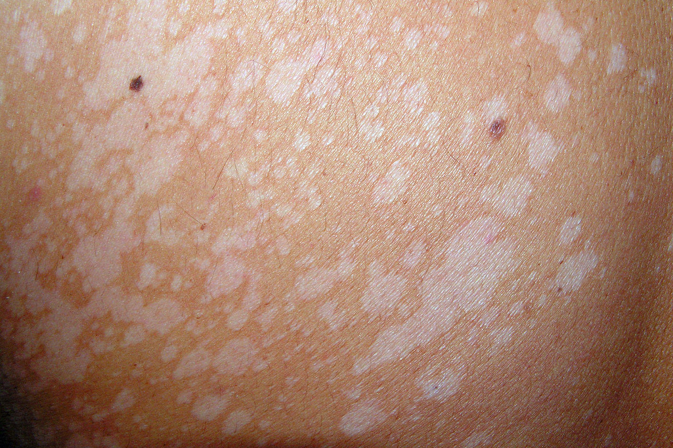 Acné